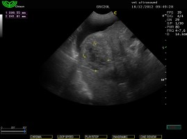 Hepatocellular carcinoma