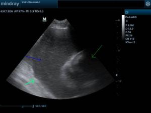 pericardial effusion