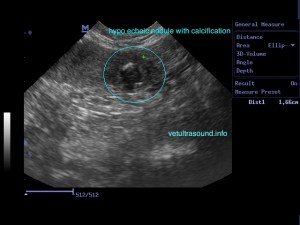 calcinosis2